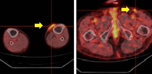 The whole body PET-CT (yellow arrow indicates accumulation of FDG).