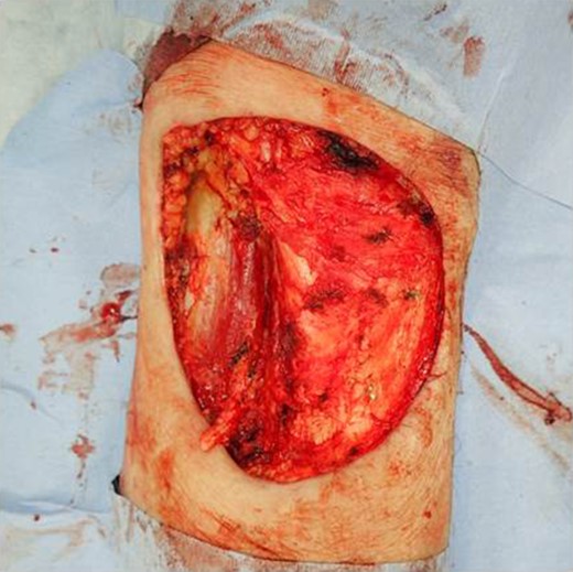 Wound after resection the tumor with a 2-cm safety margin.