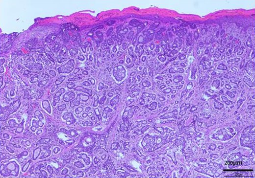 H-E stain revealed that cubical cells which had high nuclear-to-cytoplasmic ratio proliferated with cribriform, tubular or cord-like structure in the dermis and subcutaneous tissue.
