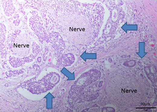 Perineural invasion by the tumor (blue arrows indicate the tumor).