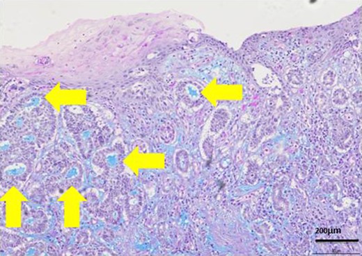 Most lumens had mucus which was stained blue by AL-B and PAS stain (yellow arrows). It showed lumens had acid mucopolysaccharide like sialomucin.