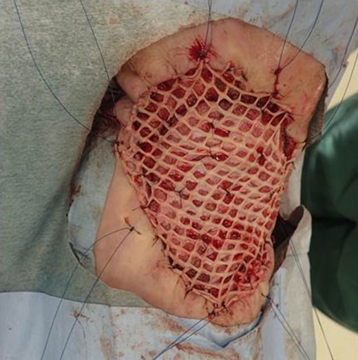 The defected wound was covered with free mesh skin graft.