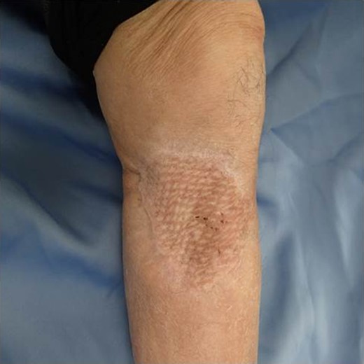 Local condition one year after the reconstructive operation.