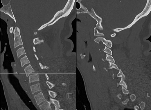 Preoperative CT, sagittal images through the center (left) and right side (right), illustrating the C5-6 fracture-subluxation and right jumped facet.