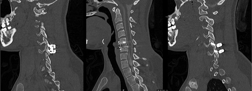 Postoperative CT-myelogram, sagittal images through the left (left), center (center) and right (right) sides, illustrating good realignment and incipient fusion at C5-6.