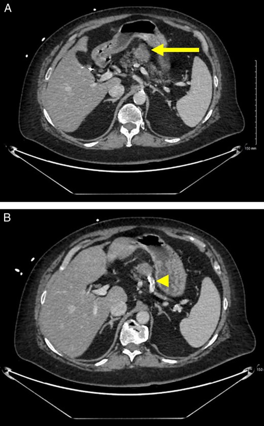 Preoperative imaging. (A) CT scan with IV contrast demonstrates a lobulated, heterogeneous, exophytic, enhancing mass (arrow) in the mid-body of the pancreas. (B) There is abutment of a calcified splenic artery (arrowhead).