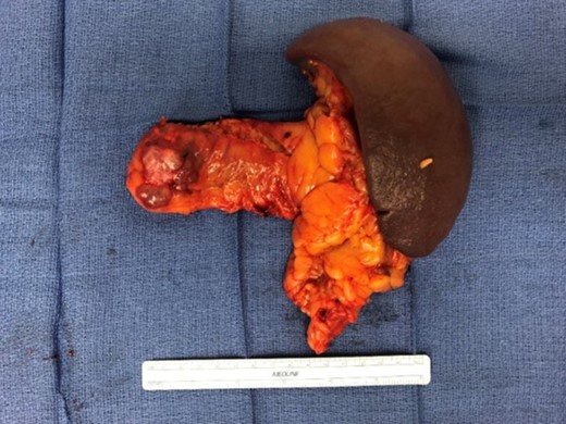 Gross pathology. A complex, heterogeneous mass with cystic component is seen in the body of the pancreas.