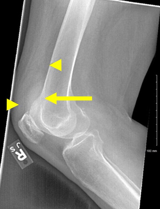 Right lateral knee radiograph. The joint effusion (arrow) can be most clearly visualized between normal anterior anatomic fat pads, the quadriceps and prefemoral (arrowheads).