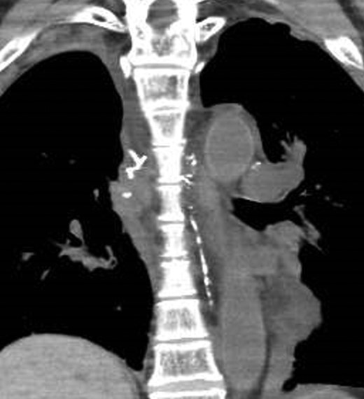 A CT image immediately after lymphangiography shows the thoracic duct coursing in the left thorax (arrow).