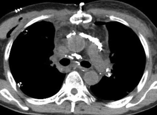 A CT image 1 day after lymphangiography shows lipiodol accumulation in the anterior mediastinum and between the bilateral main bronchi and aorta.