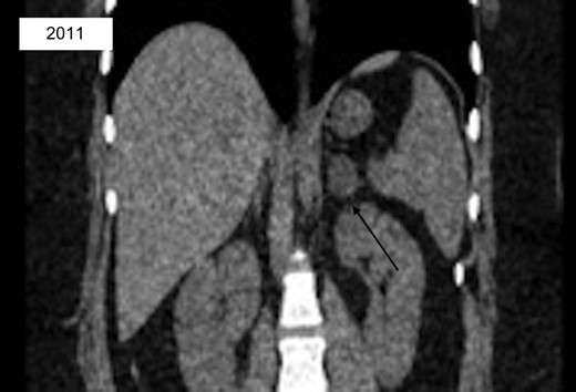 CT abd/pelvis with incidental finding of left 2.7 Ă— 2.1 cm low-density adrenal lesion consistent with adenoma.