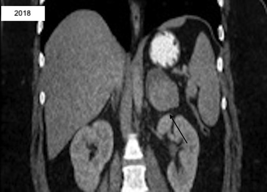 CT abd/pelvis revealing interval enlargement with heterogeneous density, now 5.0 × 6.2 cm with eccentric hyperdense region.