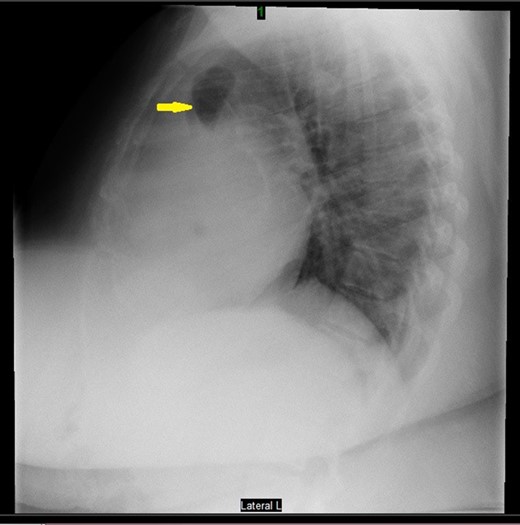 Preoperative chest X-ray revealed bowel gas.