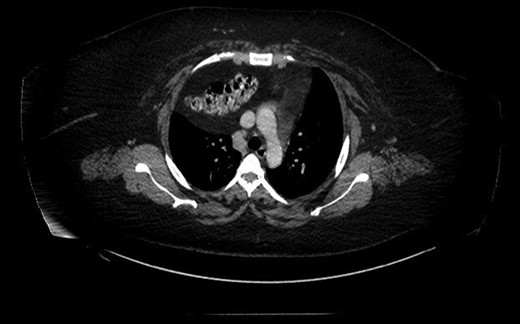 CAT scan thorax and abdomen revealed a right-sided large morgagni diaphragmatic hernia.