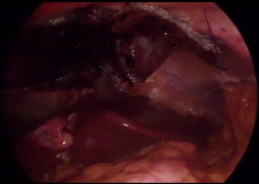 Laparoscopic sleeve gastrectomy with concomitant Morgagni hernia repair.