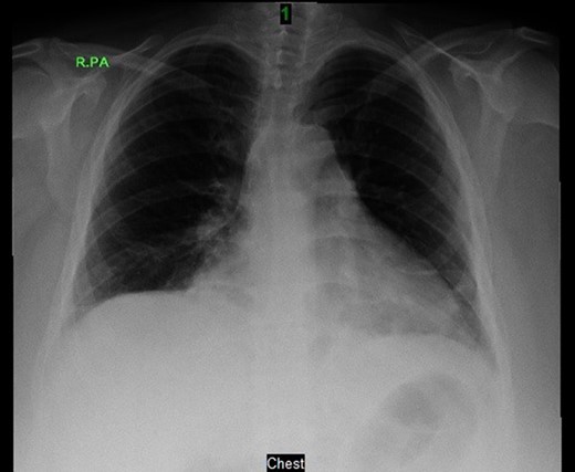 Post-operative chest X-ray.