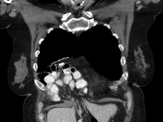 Preoperative CT scan of chest demonstrating the wide retroxyphoid defect in the diaphragm with herniated small bowel and colon into the right inferior hemithorax.