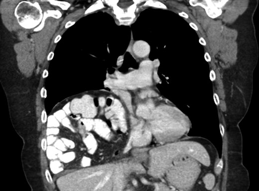 Another slice of the CT scan of the chest revealing the large size of this Morgagni hernia with multiple loops of small bowel and colon in the right inferior hemithorax.