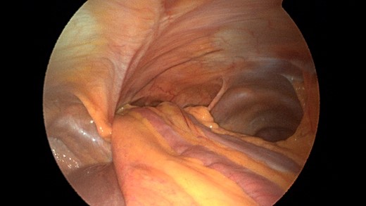 Laparoscopic view of the retroxyphoid defect in the diaphragm demonstrating multiple loops of small bowel and colon.