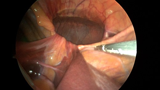 Closer view of the retroxyphoid defect demonstrating its large size with the edge of the diaphragm unattached to the undersurface of the abdominal wall.
