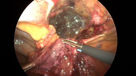 View after the parietal peritoneal hernia scan has been dissected out from the mediastinum with the sac hanging down.