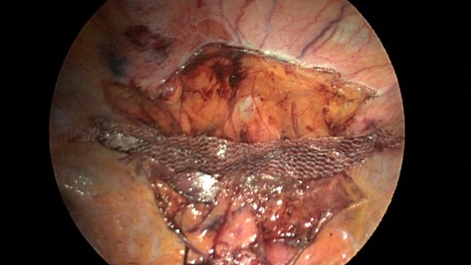 A sleeve of Parietex composite mesh cut to act as a suture bolster under the diaphragm edge to prevent the sutures from pulling through the diaphragm muscle.