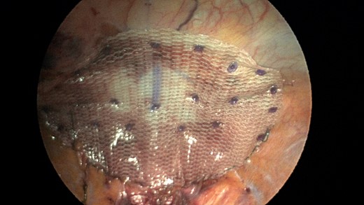 Completed view of the second main mesh piece placed with overlap of the defect and tack fixation in place.