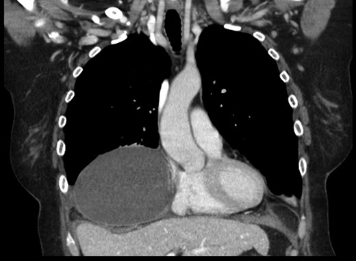 One month postoperative CT chest revealing a large seroma had formed in the area of the previous hernia.