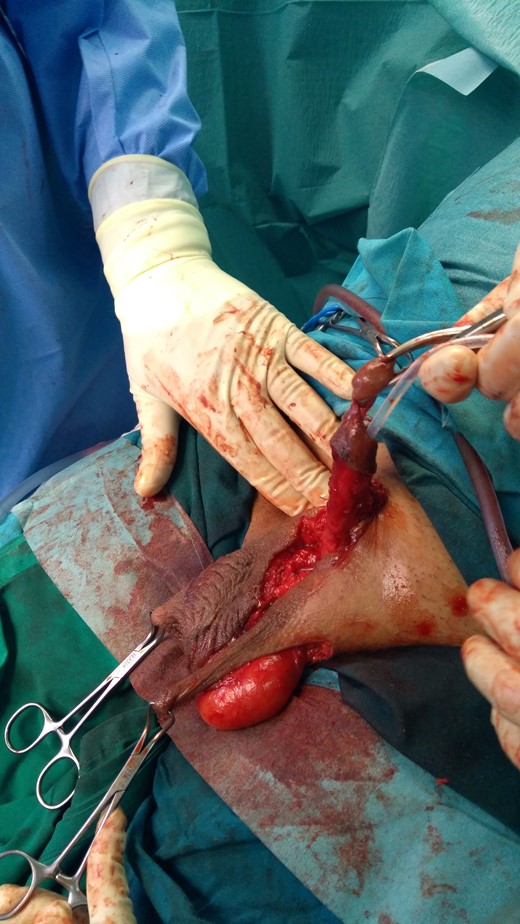 Intraoperatively: a two dartos-fascio-myo-cutaneous flaps were designed to cover the shaft.