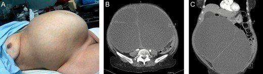 A: Giant abdominal mass. B: Contrast-enhanced CT: Giant mass with heterogeneous contrast enhancement on its wall, and filled with a heterogeneous fluid. C: Contrast-enhanced CT: Giant mass, that displaced most of the abdominal contents.