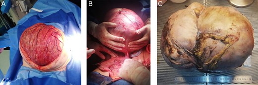 (A) Surgery, Giant ovarian mass covered by omentum. (B) Resection of the ovarian mass from adhesions to the bowel. (C) Completely resected tumor.