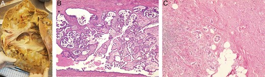 (A) Tumor had macroscopically visible papillary vegetations on the inside of the cyst wall. (B) Microscopy revealed ovarian stroma with atypical cells. (C) Appendiceal wall, invaded by atypical cells ovarian tissue.
