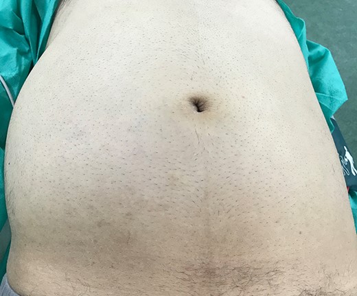 Showing a bulging mass in the right side of the abdomen.