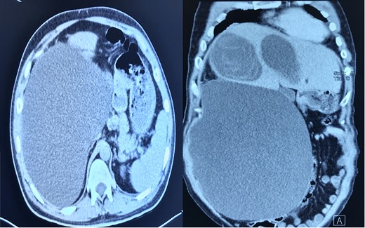 CT-scan of the abdomen showing three large cystic lesions related to the right lobe of the liver.