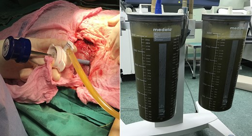 Intra-operative picture showing isolation of the cyst and initial aspiration of six liters of bile stained fluid.
