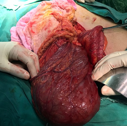 Intra-operative picture showing huge cyst mobilized outside the abdominal cavity.