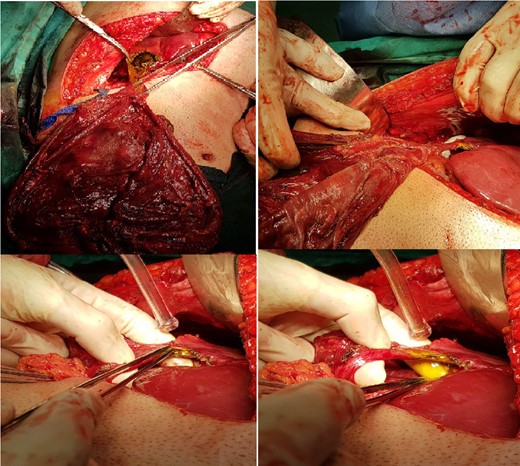Intra-operative picture showing the cyst connected by a narrow pedicle to the right lobe of the liver.