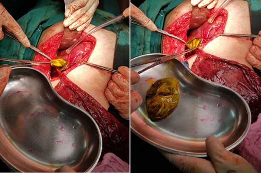 Intra-operative picture showing extraction of two laminated membrane of the hydatid cyst from the liver.
