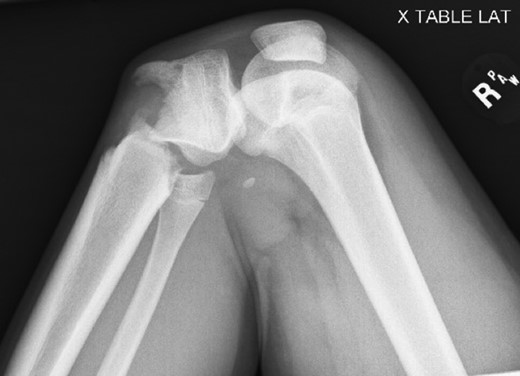 Presenting plain film view demonstrating proximal tibia fracture.