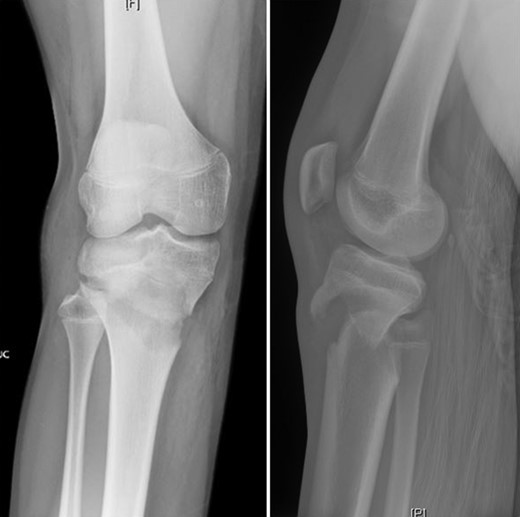 AP and lateral radiographs after attempted closed reduction which reveal type IV tibial tubercle fracture with posteromedial metaphyseal extension (Salter–Harris II variant).