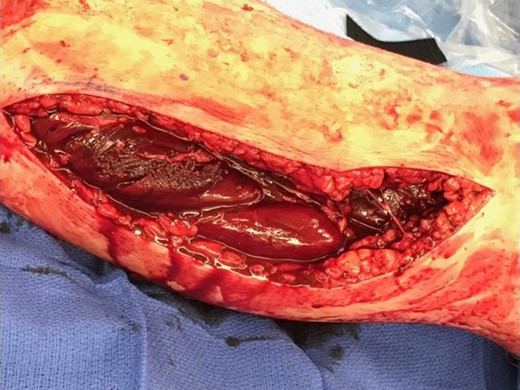 Medial fasciotomy wound revealing bulging musculature with subsequent extension of the incision for reduction.