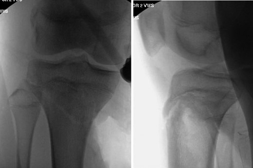 AP and lateral radiographs following open reduction and application of knee-spanning external fixator.