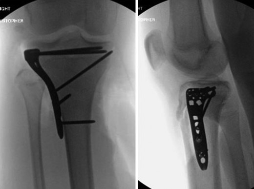 AP and lateral intraoperative fluoroscopic images following ORIF with proximal tibial locking plate.