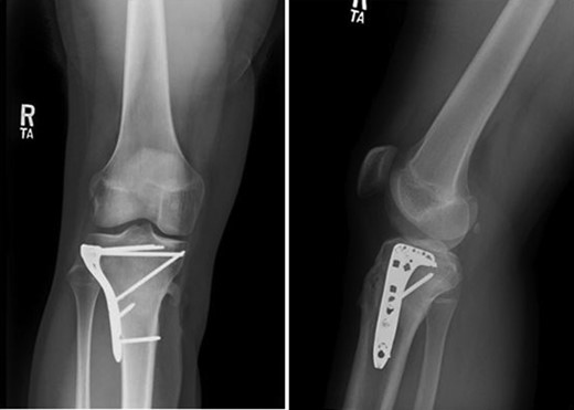 AP and lateral plain film views at 6 months post-op.