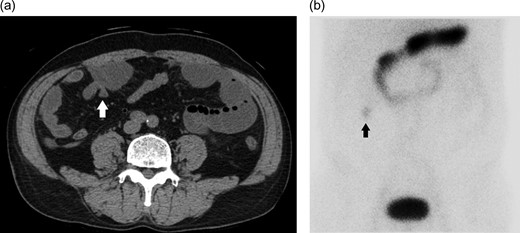 a) A structure that becomes small blind and has blind end so that it protrudes from the small intestine (white arrow). (b) Accumulation in the area close to the structure pointed out by scintigraphy (black arrow).