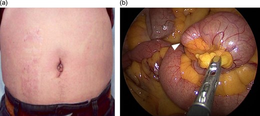 (a) 35 mm incision in the navel. (b) Accept a structure that is blinded to protrude from the small intestine (arrow head).