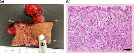 (a) Partial resection of the small intestine (diverticula length is approximately 45 mm). (b) Diverticulum mucosa composed of gastric fundus glandular mucosa.