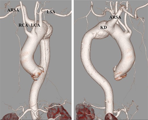 Preoperative computed tomography angiography. The Kommerell’s diverticulum with aberrant right subclavian artery. ARSA, aberrant left subclavian artery; KD, Kommerell’s diverticulum; LCA, left common carotid artery; RCA, right common carotid artery; LSA, right subclavian artery.