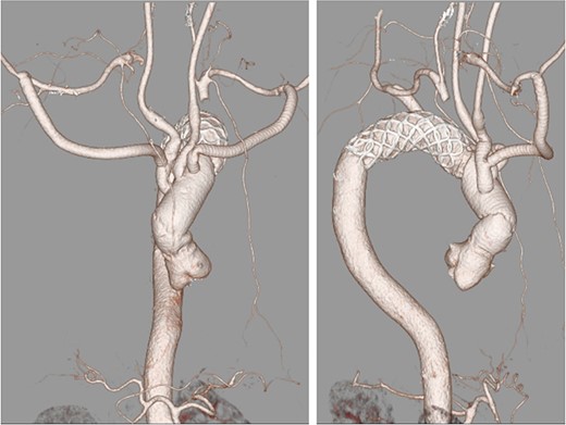 Postoperative computed tomography angiography.