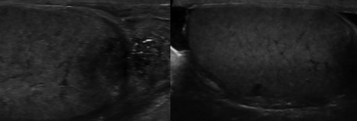 a) and (b) Ultrasound scan showing heterogeneous focus of tissue calcification within the right epididymis and granulomatous change.